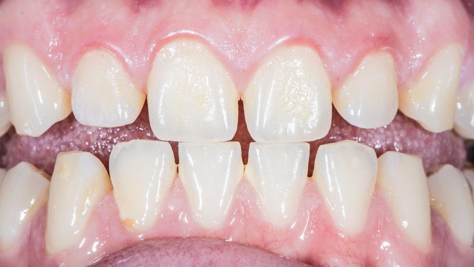 Ksylitoli voi vähentää hampaiden reikiintymistä ja ientulehdusta.