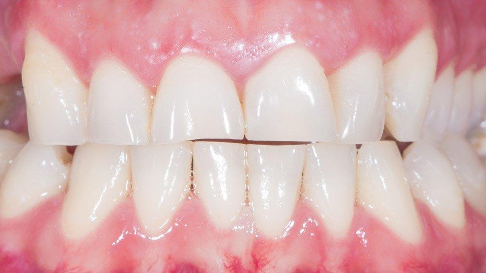 Hampaiden narskuttelun vuoksi kuluneet etuhampaat. 
