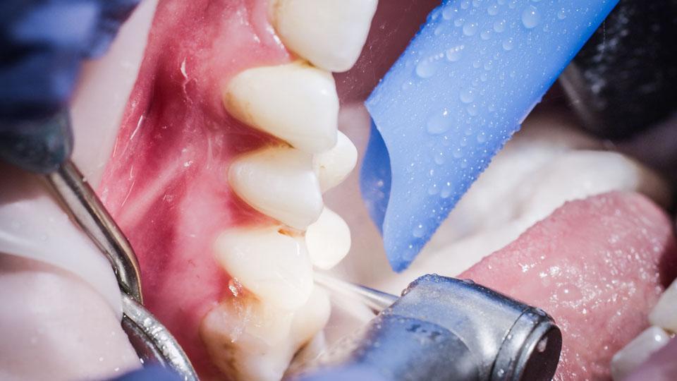 Hampaan numero kertoo yksiselitteisesti ja luotettavasti esimerkiksi hoitoa vaativan hampaan paikan suussa.