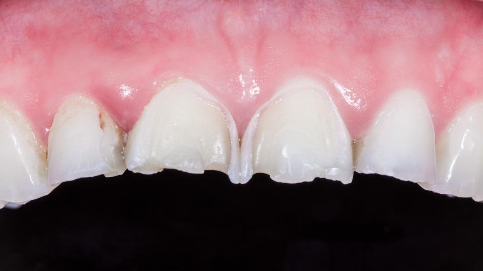 Hampaiden eroosio voi johtua happamista juomista tai refluksitaudista.