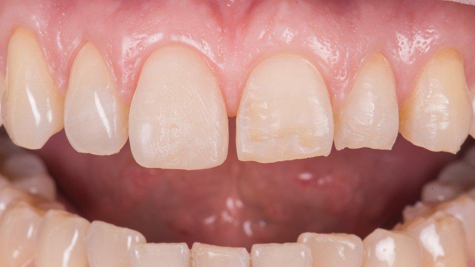 Hampaiden korjaus yhdistelmämuovilla.