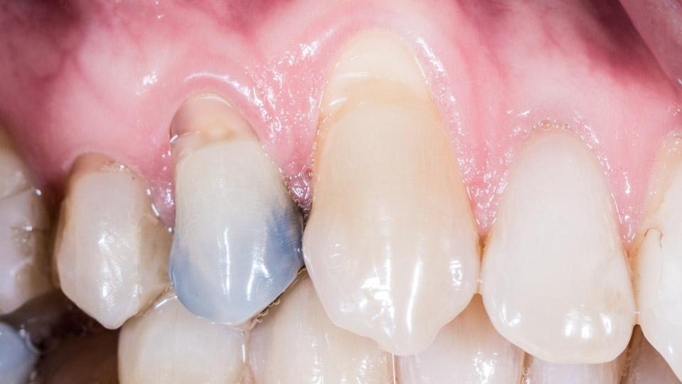 Väärä harjaustekniikka tai liian kova hammasharja voivat aiheuttaa ikenien vetäytymistä ja hampaan kaulaosan kulumaa. Harjausvaurio aiheuttaa usein hampaiden vihlontaa.
