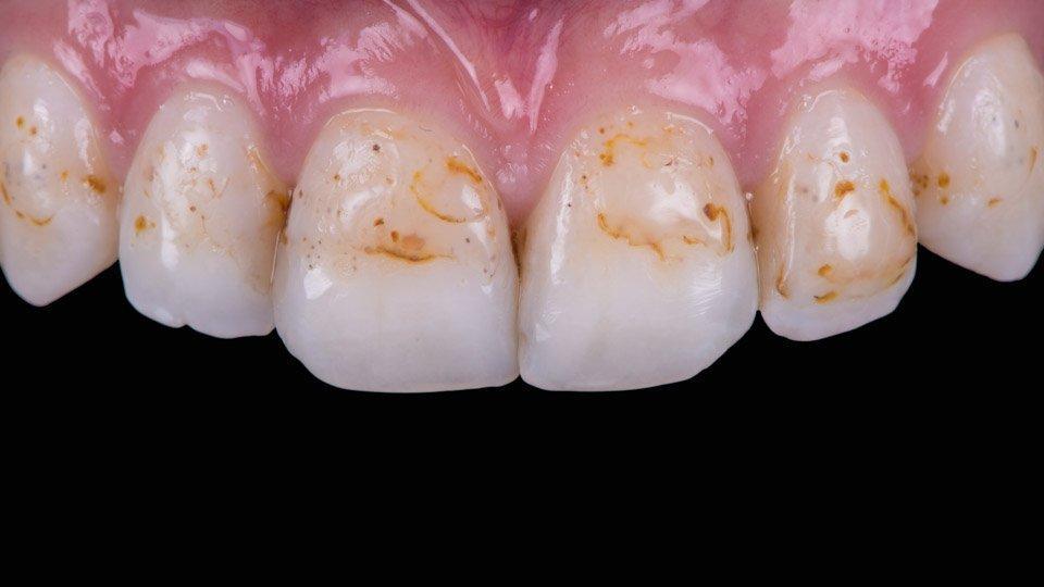 Hampaiden kiillettä ei saa takaisin mutta vauriot voidaan korjata