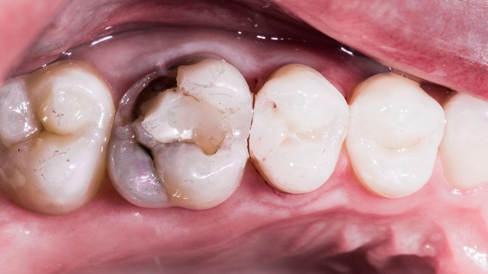 Hampaan paikkaus. Hampaan lohkeaminen ja karies ovat yleisiä syitä paikkaukselle.