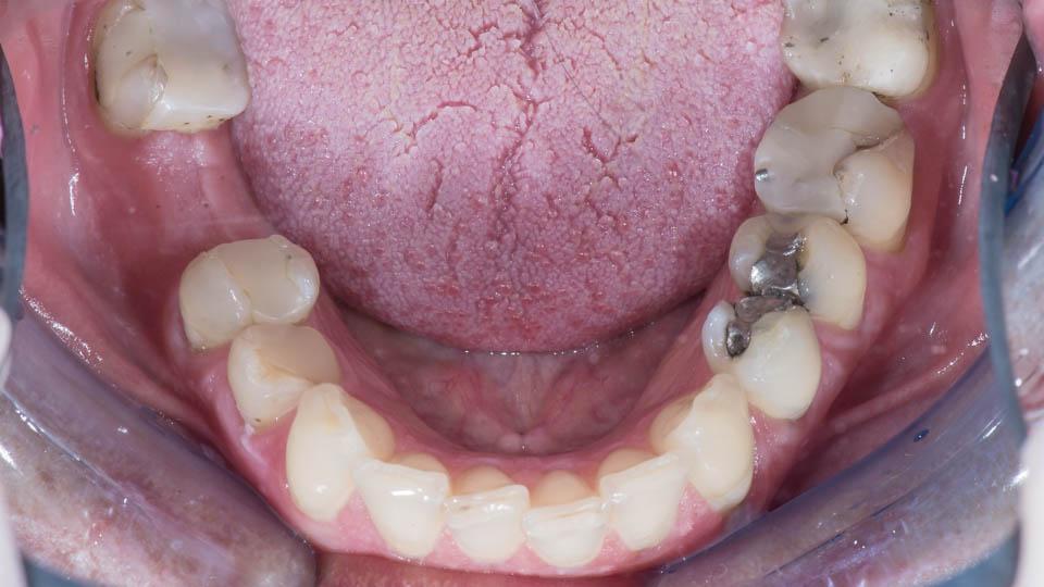 Eroosion vaurioittamat alaleuan hampaat.