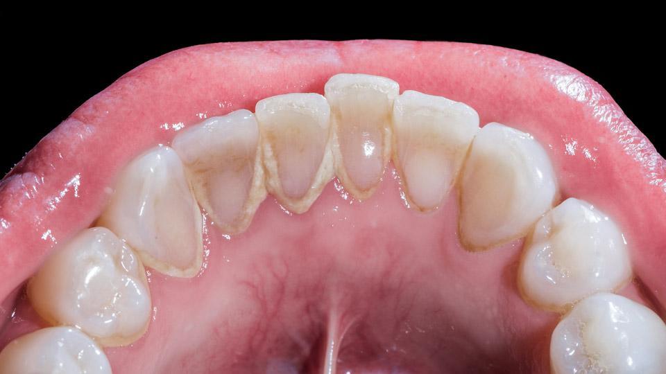 Suuvesi voi sisältää mm. fluoria, ksylitolia ja eteerisiä öljyjä. Etenkin hampaiden reikiintymisestä ja runsaasta hammaskiven muodostuksesta (kuvassa) kärsivät voivat hyötyä suuveden käytöstä.