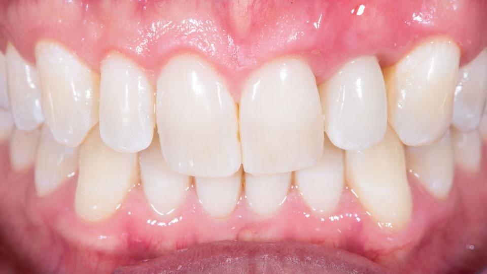 Valmis hammasimplantti. Implanttileikkauksen yhteydessä tehtiin keinoluusiirre ja iensiirre.