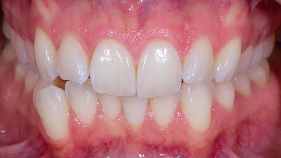 Hampaiden kulumat ennen korjausta kerrostusmuovilla