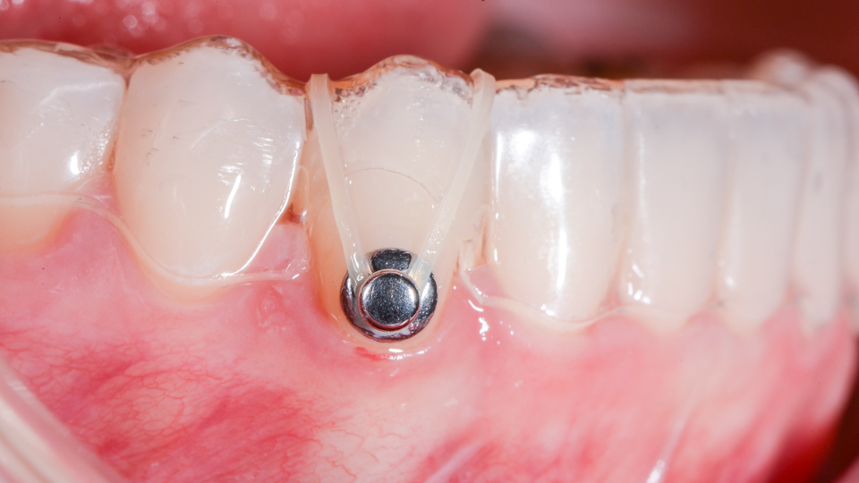 Kuminauha antaa lisävoimaa hampaan liikkuttamiseen oikomiskalvoilla